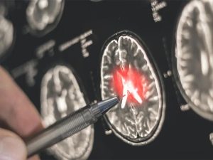 جرمن سائنسدانوں کی بڑی پیشرفت، اے آئی نظام دماغی رسولیوں کی تشخیص صرف 12 منٹ میں کرنے کے قابل